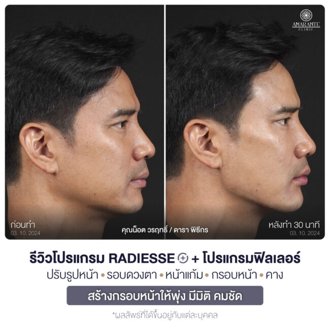 ภาพ BA คุณน๊อต หันขวาให้เห็น jawline