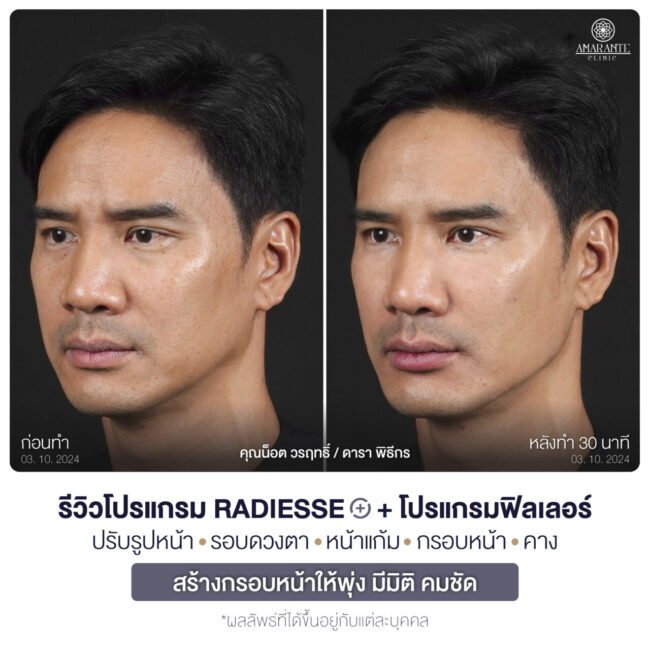 ภาพ BA คุณน๊อต หันซ้าย 45 องศา