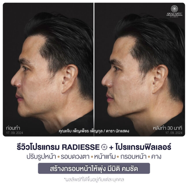 ภาพหันซ้ายโชว์ให้เห็น Jawline Before and After คุณแจ๊บ ฉีดฟิลเลอร์กับ Radiesse Plus สร้างกรอบหน้าให้พุ่ง มีมิติ คมชัด