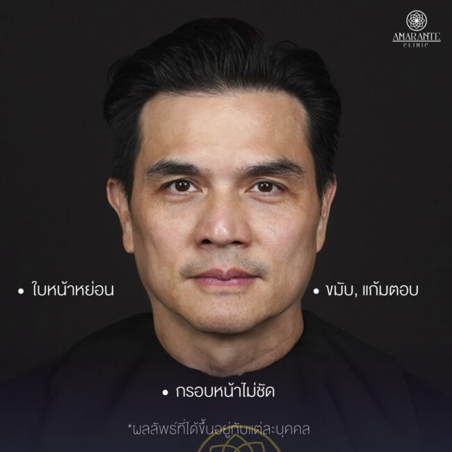 ภาพหน้าคุณแจ๊บที่มีปัญหา ใบหน้าหย่อน ขมับ แก้มตอบ กรอบหน้าไม่ชัด