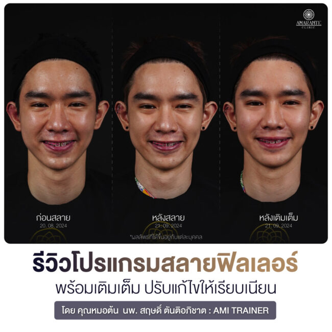 รีวิวฉีดสลายผู้ชาย
