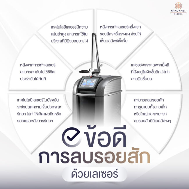 ภาพ infographic อธิบายข้อดีการลบรอยสักด้วยเลเซอร์