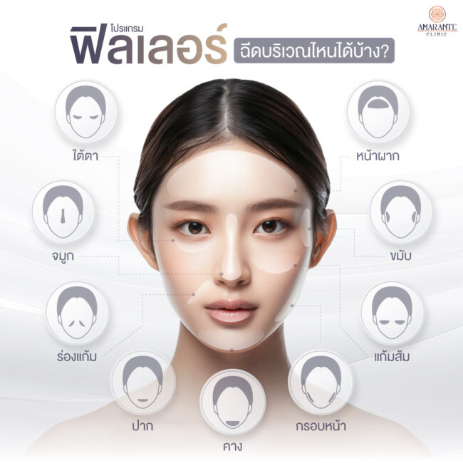 ภาพ infographic โชว์ให้เห็นจุดที่สามารถฉีดฟิลเลอร์บนใบหน้าได้