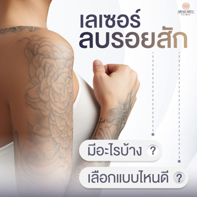 ภาพประกอบของหัวข้อ - เลเซอร์ลบรอยสักมีอะไรบ้าง? เลือกแบบไหนดี