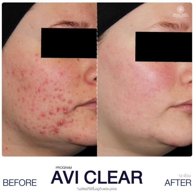 AviClear รีวิว เคส 1
