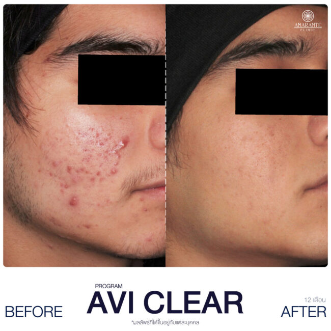 AviClear รีวิว เคส 2