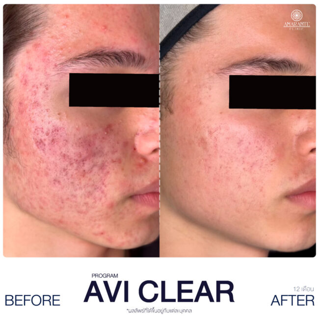 AviClear รีวิว เคส 3 ภาพ AviClear รีวิว แสดงให้เห็นผลลัพธ์ Before and After เคส 3