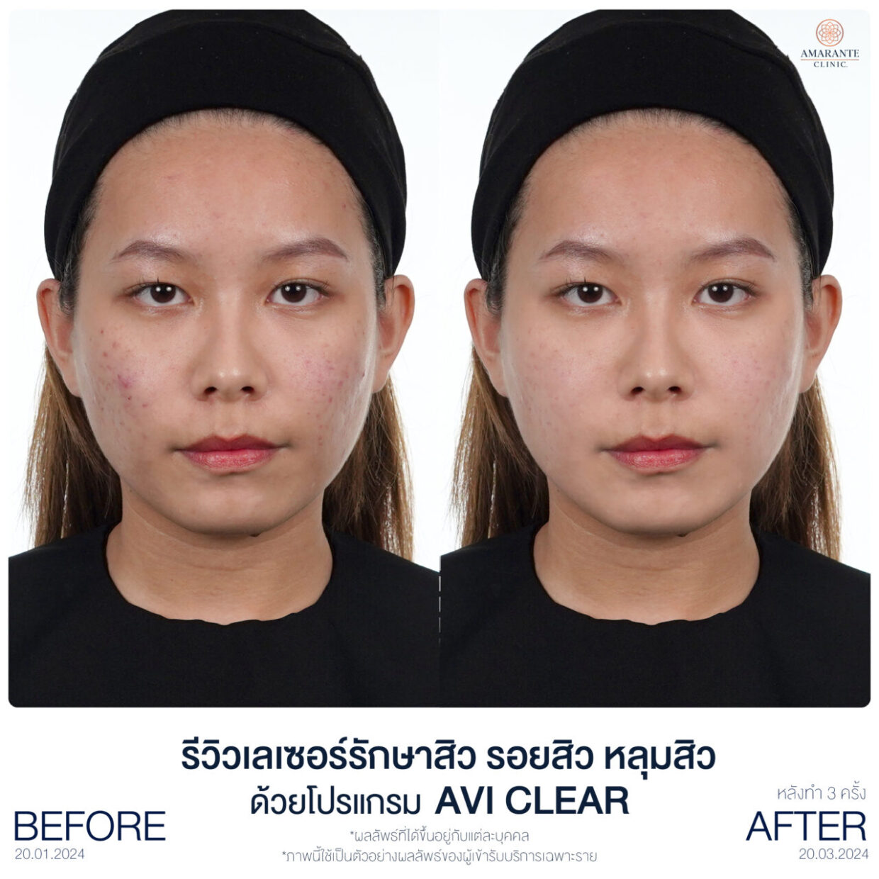 รีวิว คุณแบม ก่อนทำ หลังทำ AviClear