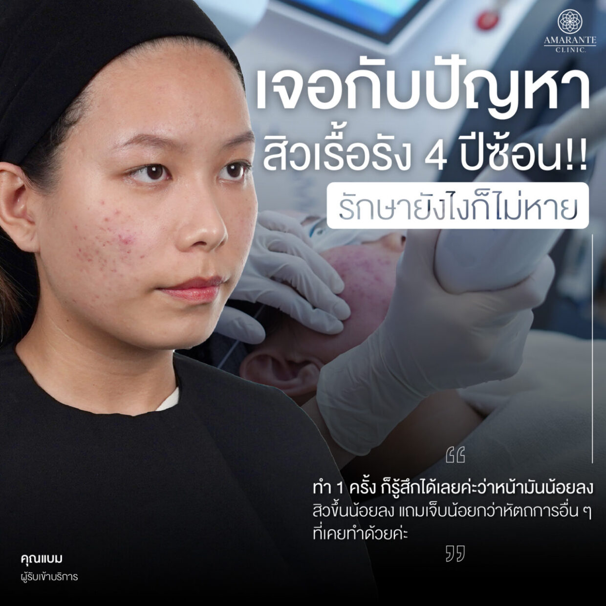 คุณแบม เจอกับปัญหาสิวเรื้อรัง 4 ปีซ้อน รักษายังไงก็ไม่หาย