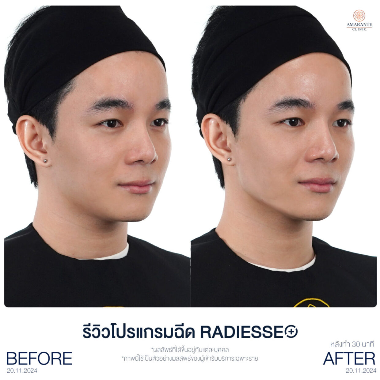 ภาพเปรียบเทียบก่อนและหลังฉีดฟิลเลอร์ Radiesse Plus ของคุณเพิ่มเห็นผลลัพธ์กรอบหน้าชัดขึ้นภายใน 30 นาที
