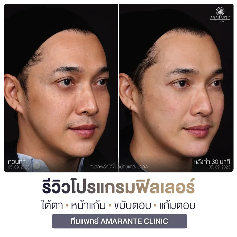 คุณอาร์ต พลังธรรม รีวิวโปรแกรมฉีดฟิลเลอร์ ด้านซ้าย