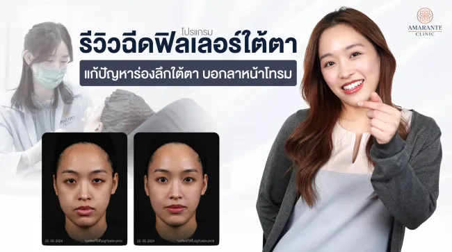 รวมรีวิวฉีดฟิลเลอร์ใต้ตา