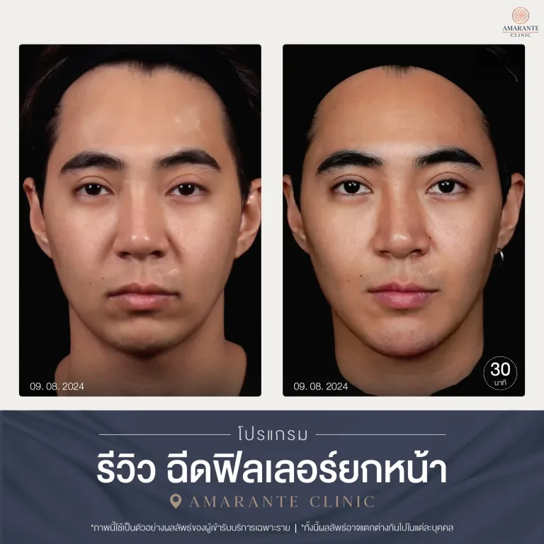 รีวิวฉีดฟิลเลอร์ยกหน้า คุณผู้ชาย