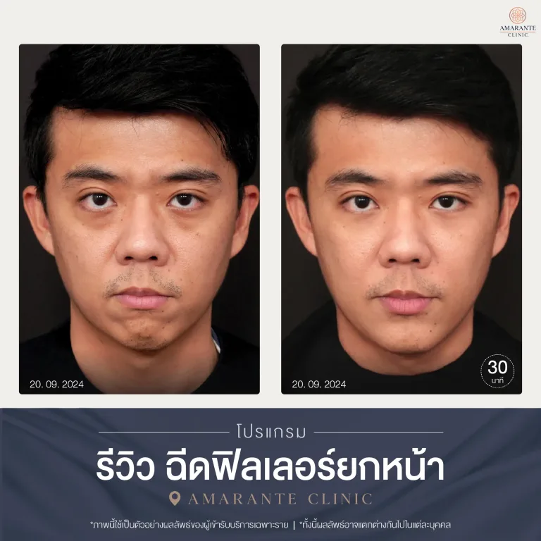 รีวิวฉีดฟิลเลอร์ยกหน้า