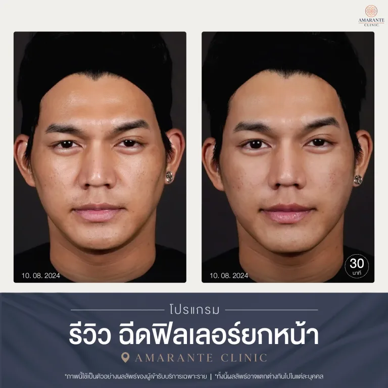 รีวิวฉีดฟิลเลอร์ยกหน้า ปรับรูปหน้า