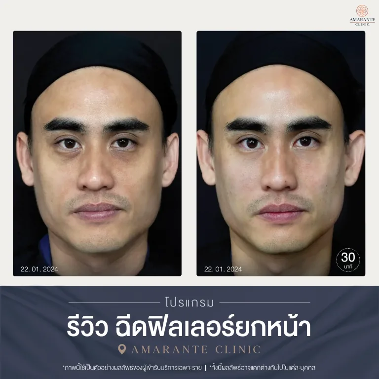 รีวิวฉีดฟิลเลอร์ยกหน้า