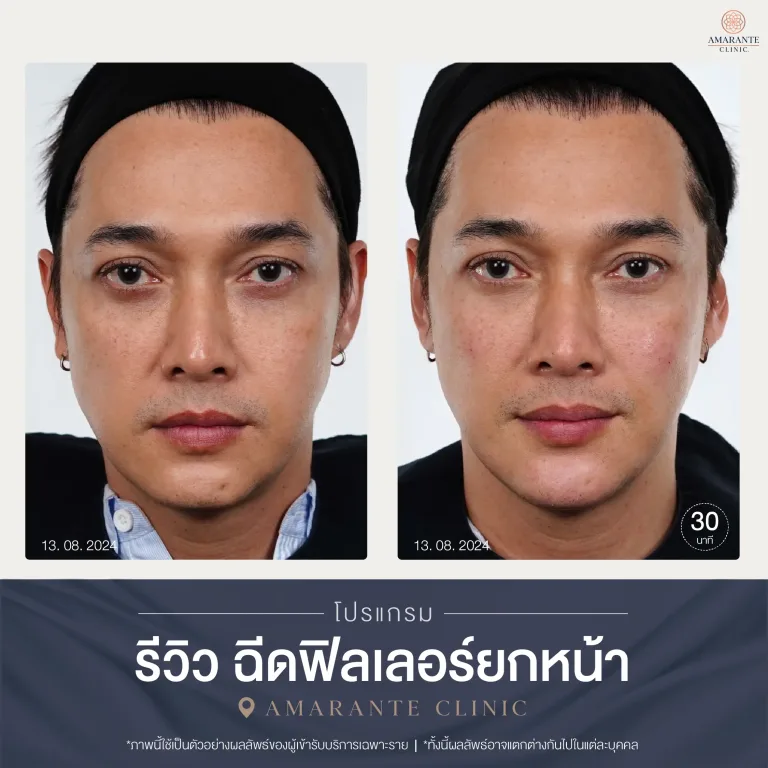 รีวิวฉีดฟิลเลอร์ยกหน้า คุณอาร์ต