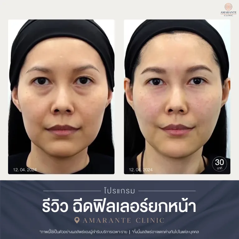 รีวิวฉีดฟิลเลอร์ยกหน้า คุณผู้หญิง