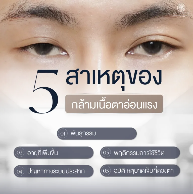 ภาพ infographic อธิบาย 5 สาเหตุของโรคกล้ามเนื้อตาอ่อนแรง