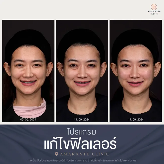BA สลายฟิลเลอร์-06