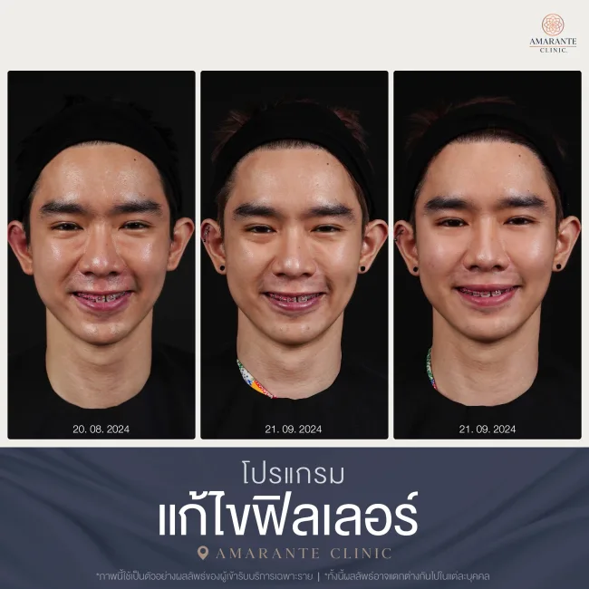 BA สลายฟิลเลอร์-09