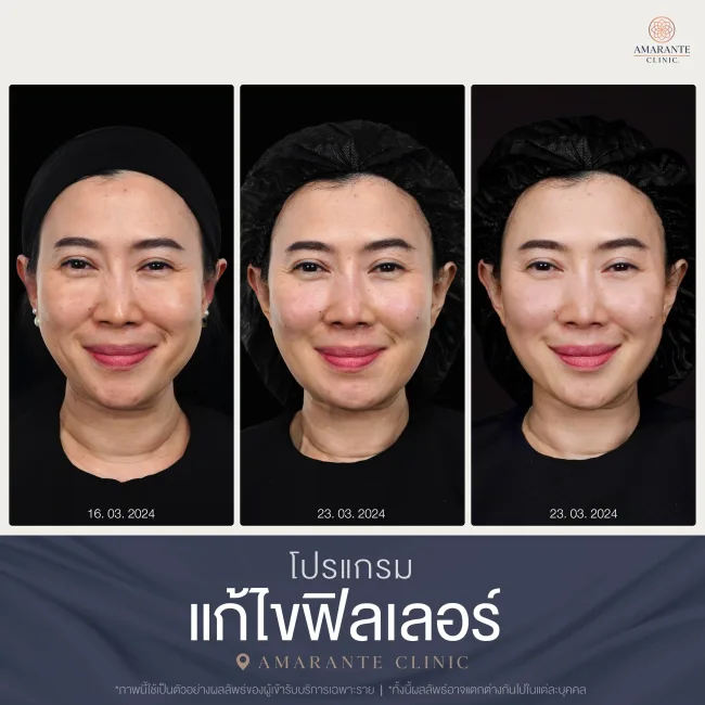 BA สลายฟิลเลอร์-10
