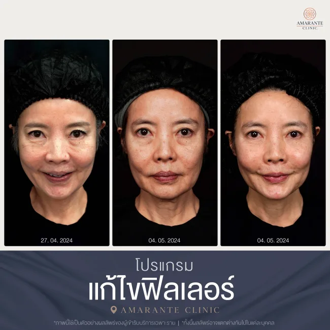 BA สลายฟิลเลอร์-11