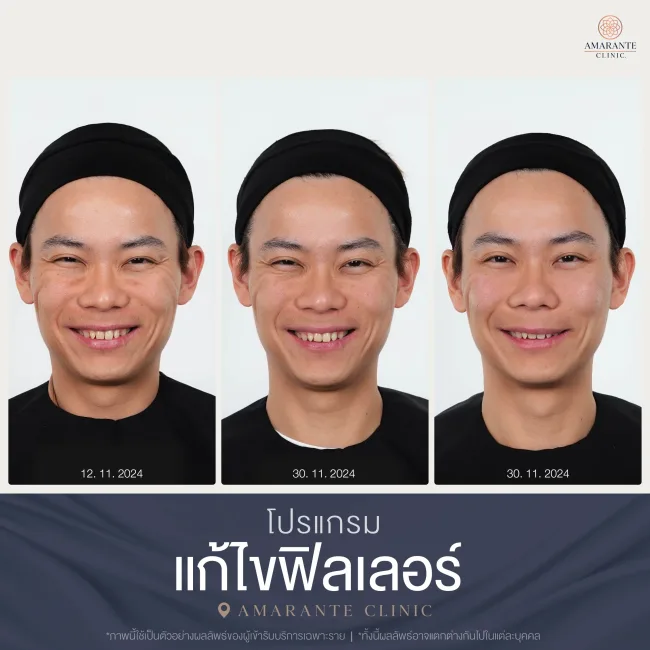 BA สลายฟิลเลอร์-15