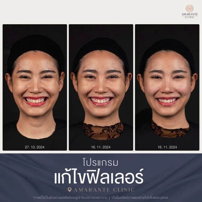 BA สลายฟิลเลอร์-16