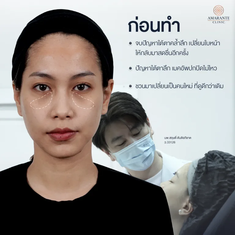 คุณมุก โปรแกรมฉีดฟิลเลอร์ใต้ตา