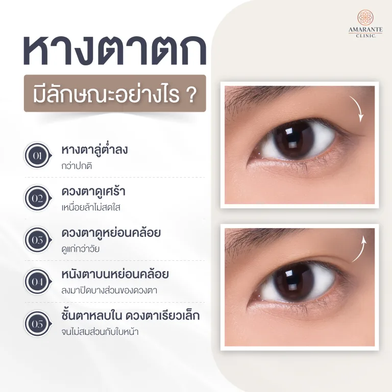 ภาพ infographic อธิบาย หางตาตกมีลักษณะอย่างไร?