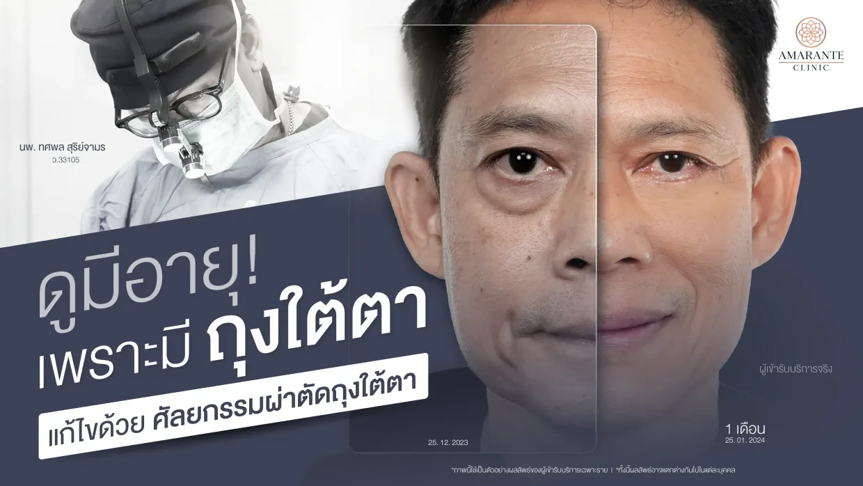 ศัลยกรรม ผ่าตัดถุงใต้ตา คลายความอ่อนล้า