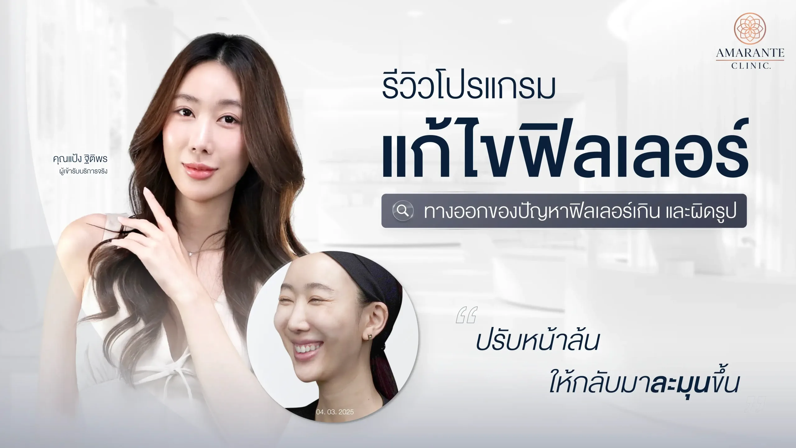 ปกภาพบทความ รีวิวสลายฟิลเลอร์ คุณแป้ง ฐิติพร แก้ไขฟิลเลอร์โดย Amarante Clinic