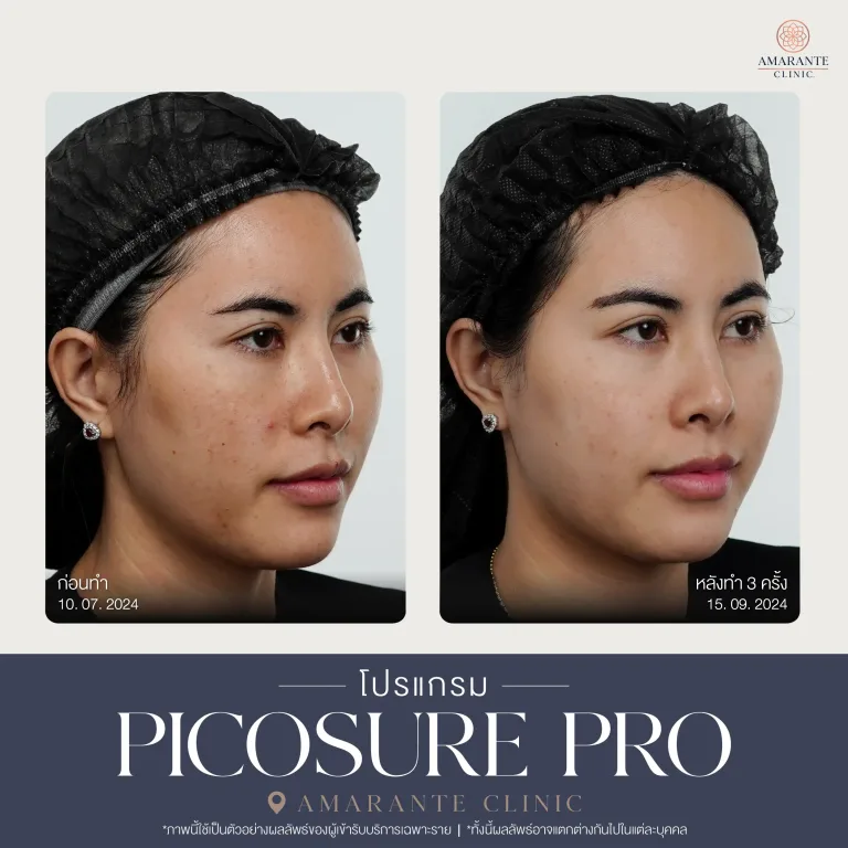 รีวิว Picosure pro 13