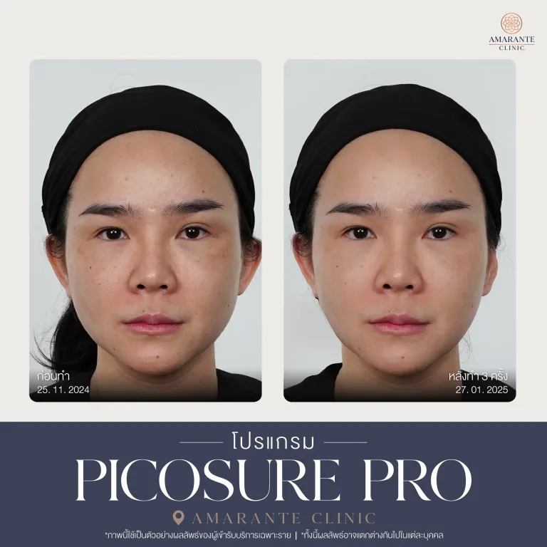 รีวิว Picosure pro 14