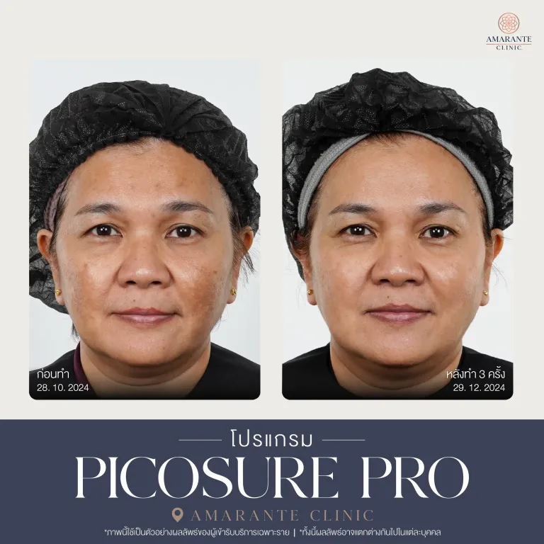 รีวิว Picosure pro 15
