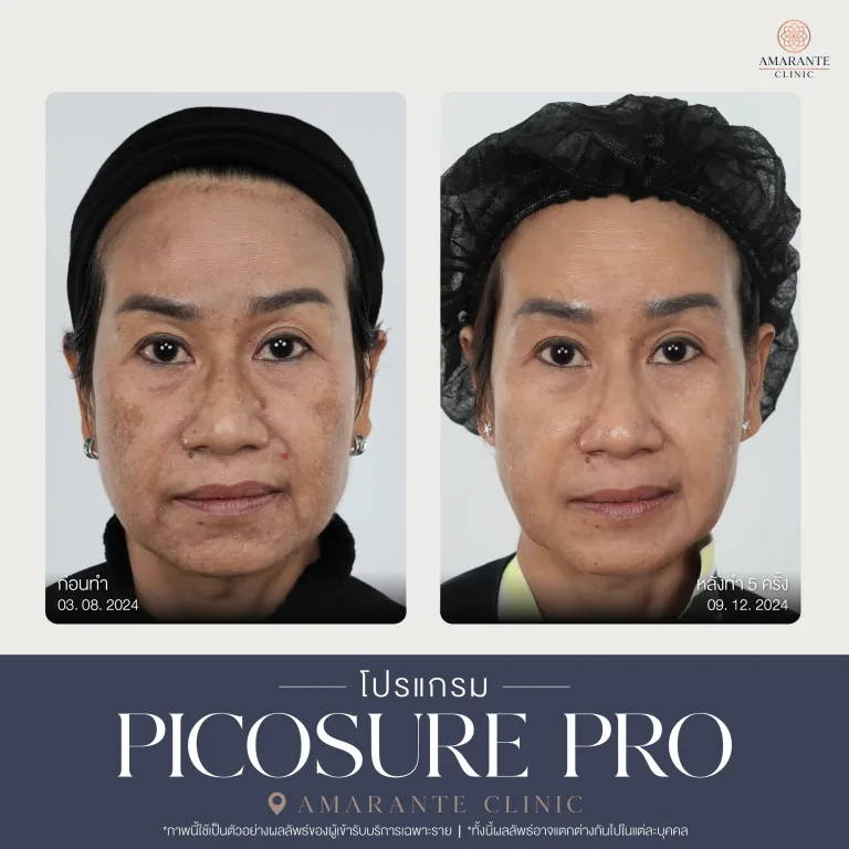 รีวิว Picosure pro 17