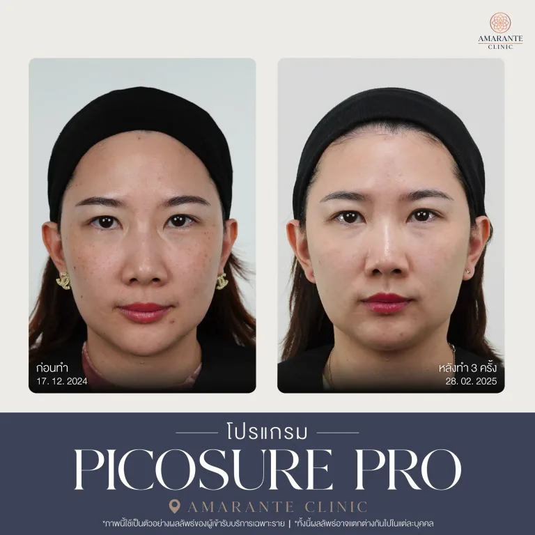 รีวิว Picosure pro 18