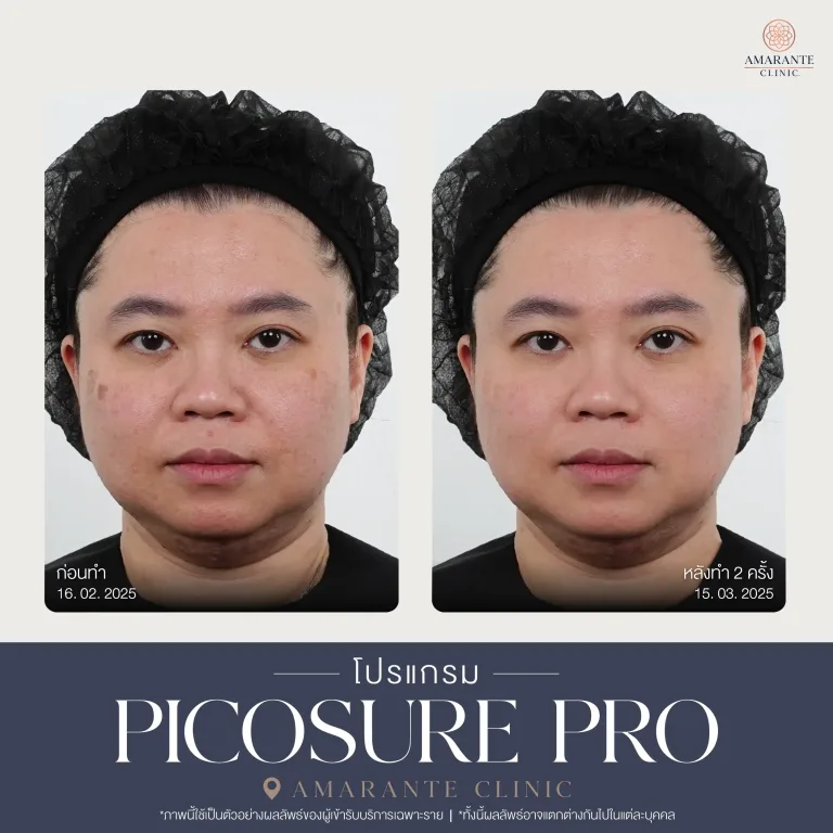 รีวิว Picosure pro 19