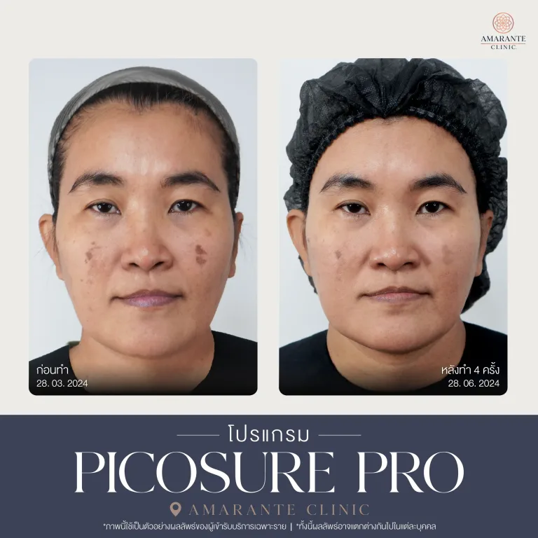 รีวิว Picosure pro 20