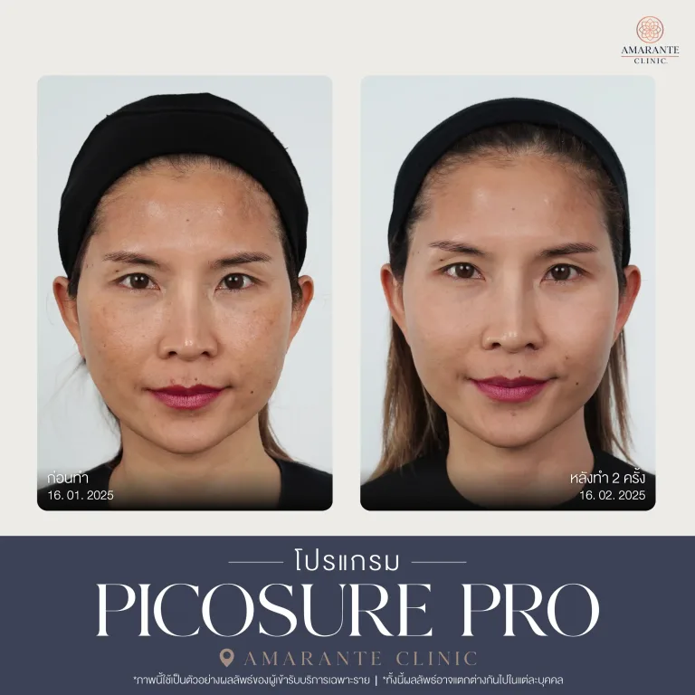 รีวิว Picosure pro 21