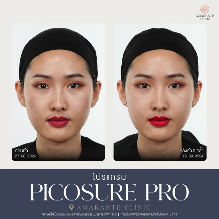 รีวิว Picosure pro 22