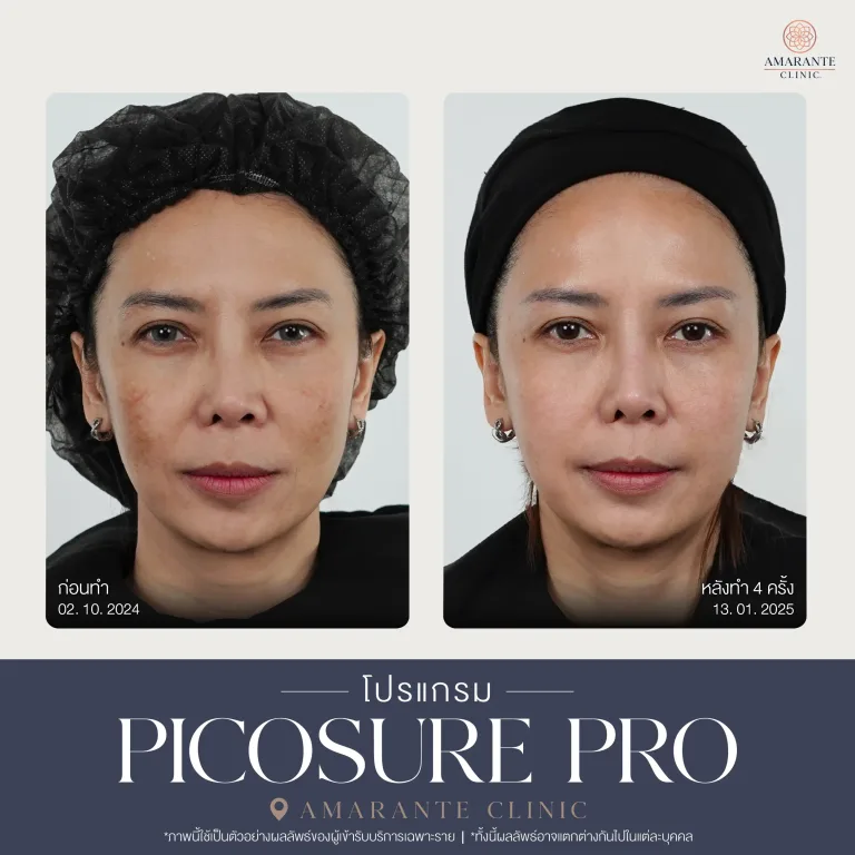 รีวิว Picosure pro 23