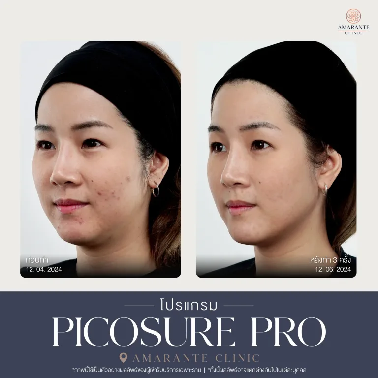 รีวิว Picosure pro 24