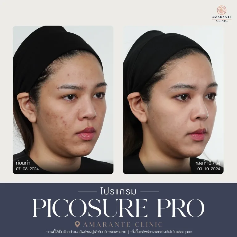 รีวิว Picosure pro 25