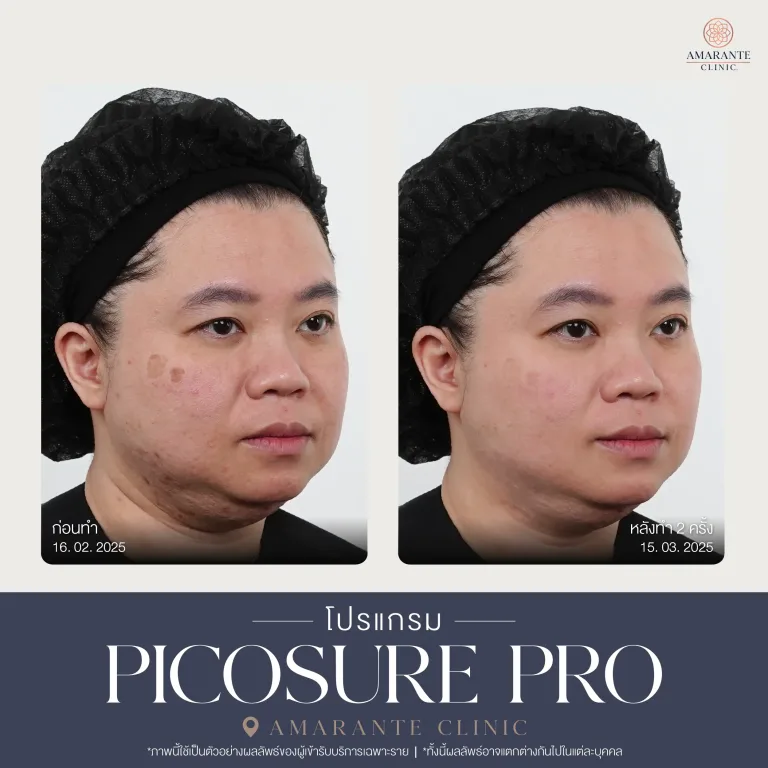 รีวิว Picosure pro 26