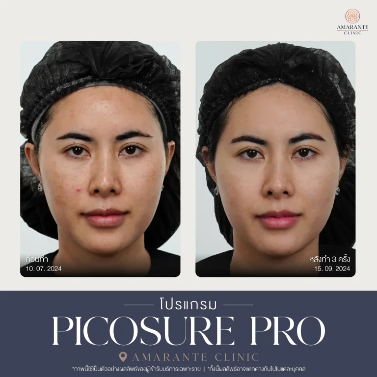 รีวิว Picosure pro 27