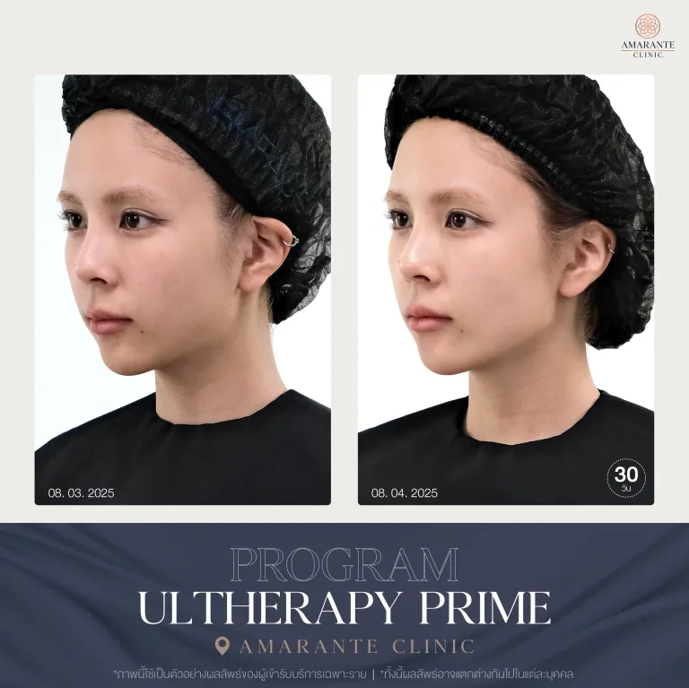 ภาพ Before and After ของคุณอิ๊นทำ Ulthera Prime