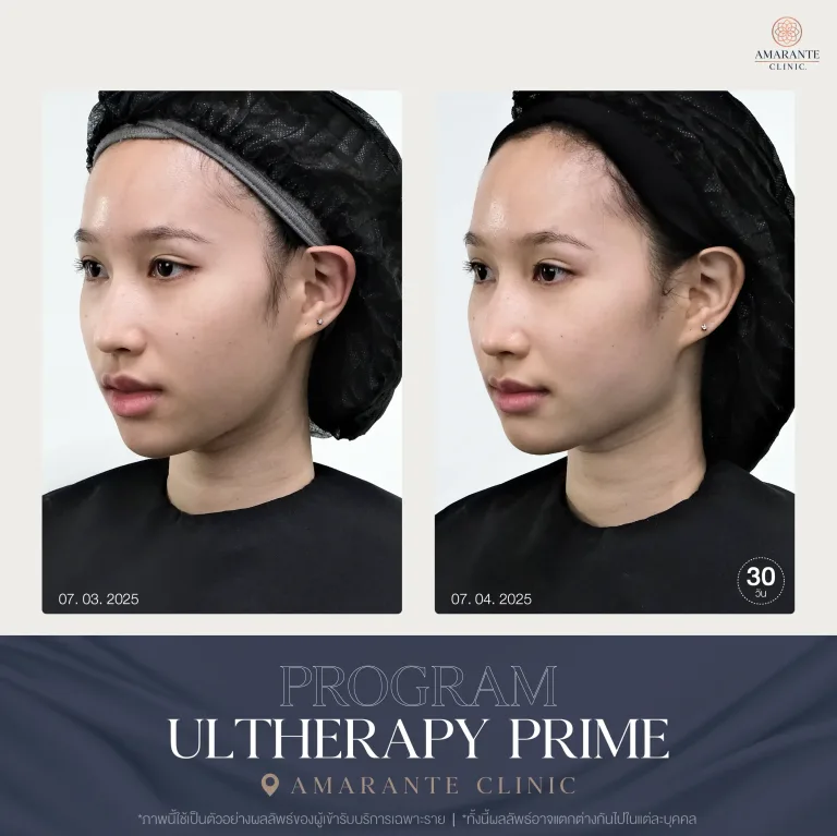 ภาพ Before and After ของคุณเกรซทำ Ulthera Prime