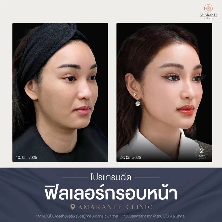 โปรแกรมฉีดฟิลเลอร์กรอบหน้า-01